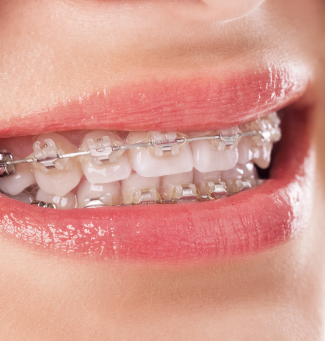 Six Month Braces FREE Consultation, Fast Braces